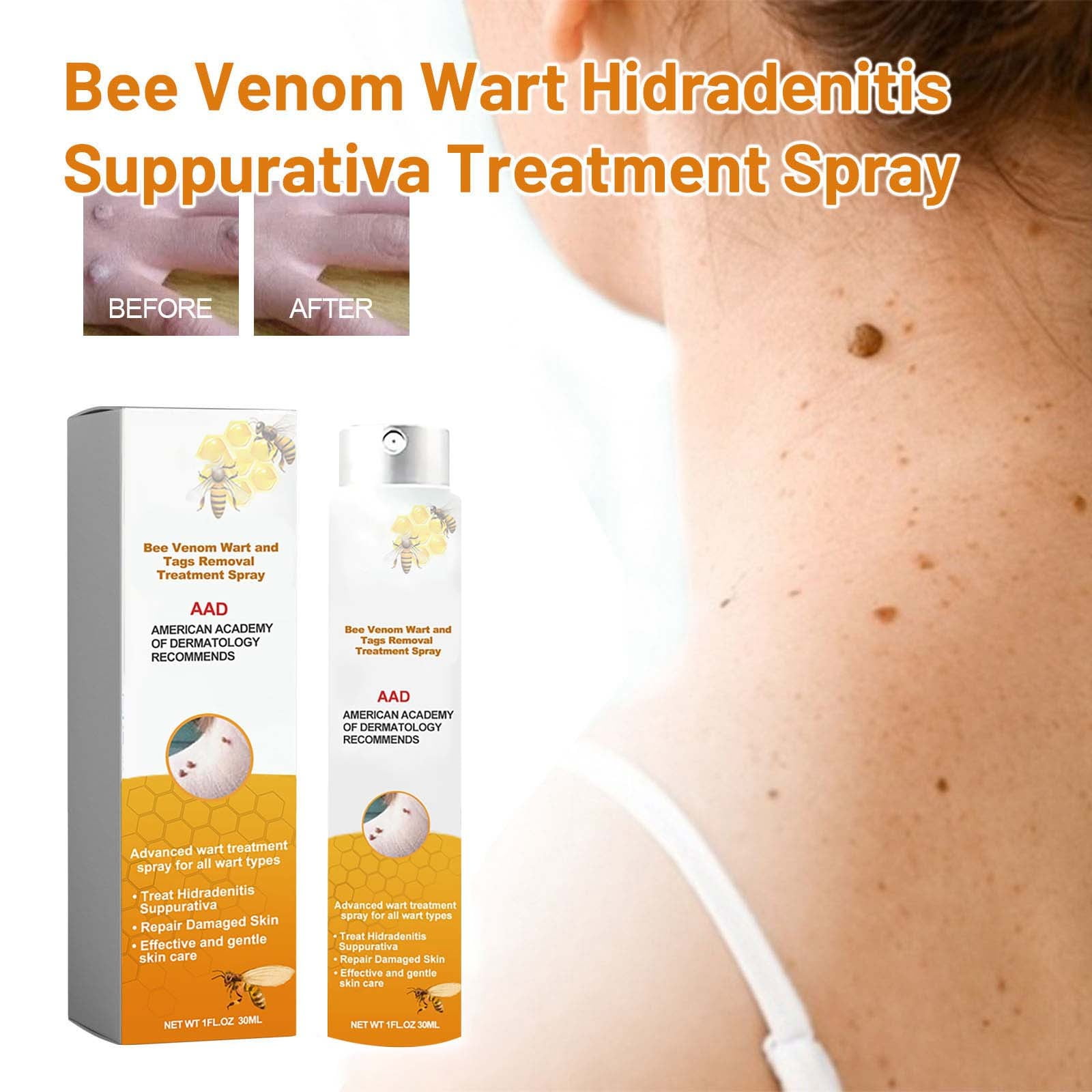 Body Care Kit Vitamin E Oil Wart Care Spray 20ml Skin Cleansing