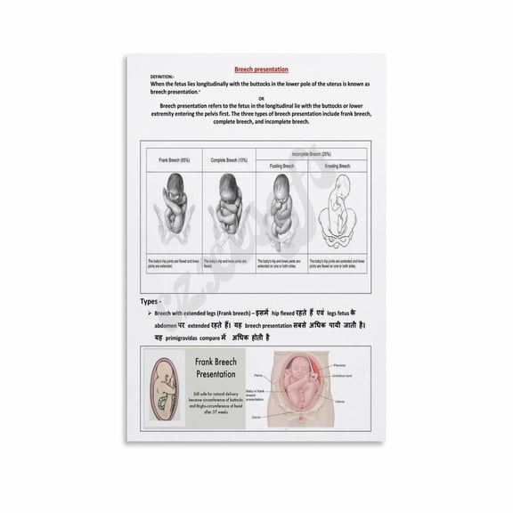 Breech Presentation Poster Pregnancy Education Wall Art Obstetrics Clinic Decor (2) Canvas Painting Wall Art