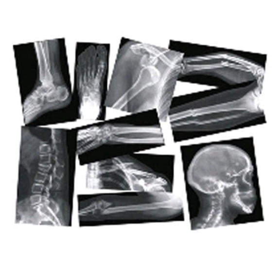 Broken Bone Compound Fracture X-Rays