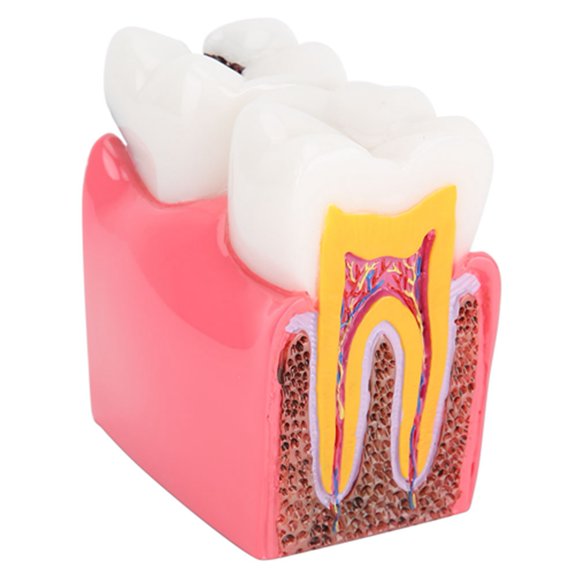 Brynna Caries Comparison Study Model Anatomy Model, Resin Teeth Model for Oral Care for Laboratory