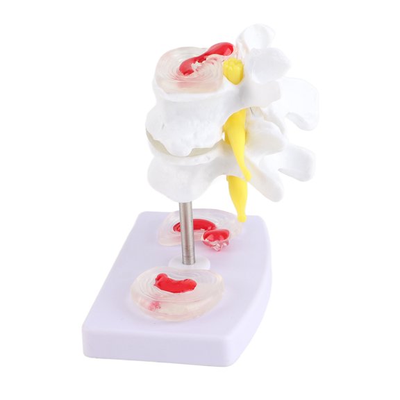 Brynna Teaching Instrument Lumbar Model, Human Spine Model Mounted Securely with 2 Diseased Intervertebral Discs for School
