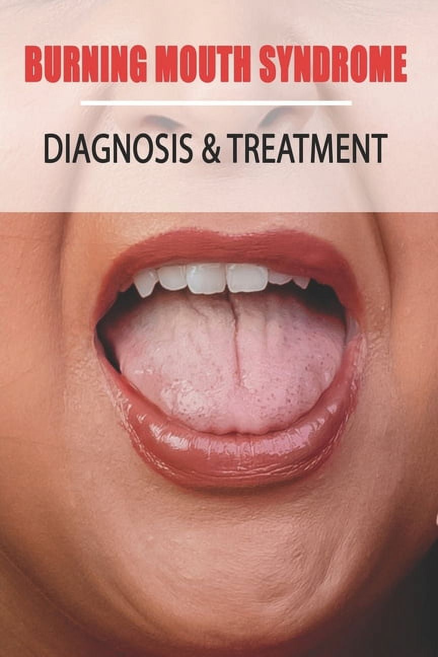 ENOCH NARCISO Burning Mouth Syndrome: Diagnosis & Treatment: Burning Mouth Syndrome Guide, (Paperback)
