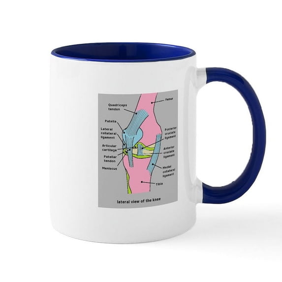 CafePress - Knee Joint Mug - 11 oz Ceramic Mug - Novelty Coffee Tea Cup