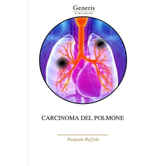 Carcinoma del Polmone, (Paperback)