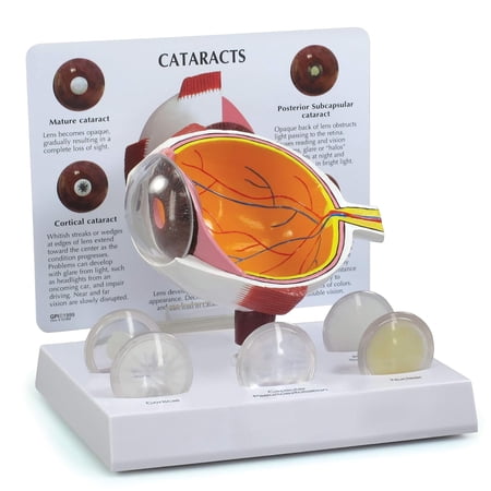 Cataract Eye Model, Replica of an Eye with Cataract Conditions for Human Anatomy, Physiology Education, Anatomy Model for Doctor's Office and Classrooms, Medical Learning Resources