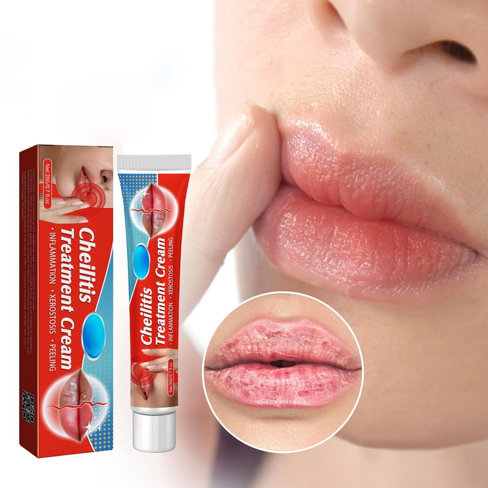 Cheilitis Treatment Cream Repairing Antibacterial Chapped Wrinkle Rehydration Reduce Fine Lines Lip Inflammation Labial Ointment Walmart