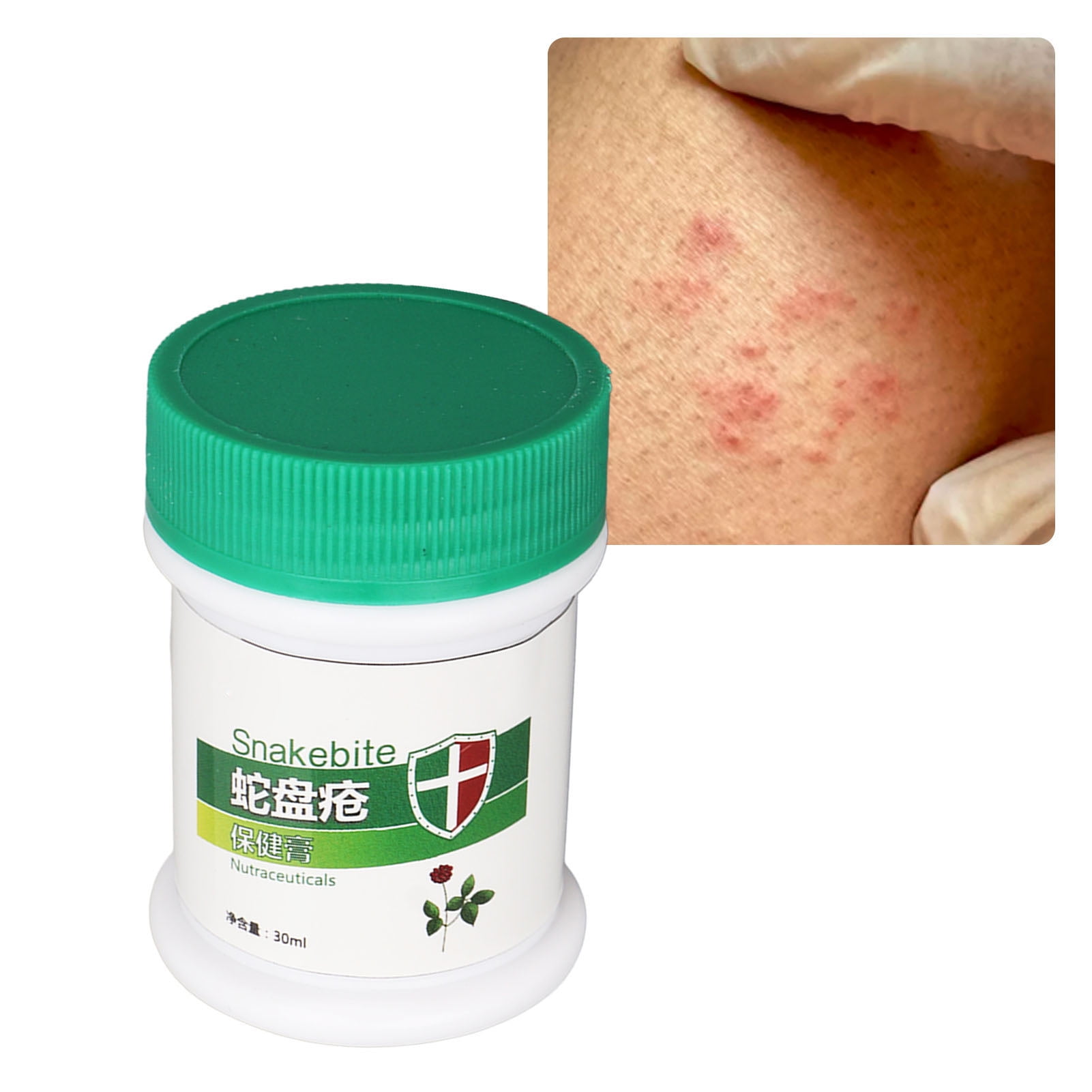 Chicken Pox Treatment Cream, Herpes Zoster Cream Multifunctional For