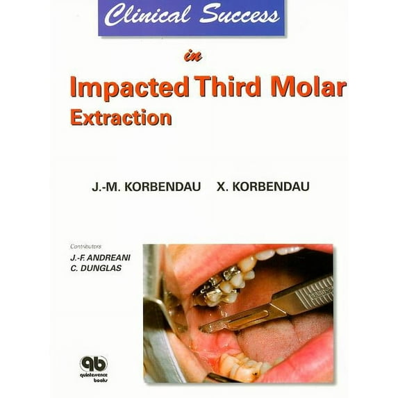 Clinical Success: Clinical Success in Impacted Third Molar Extraction (Paperback)
