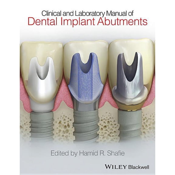 Clinical and Laboratory Manual of Dental Implant Abutments (Hardcover)