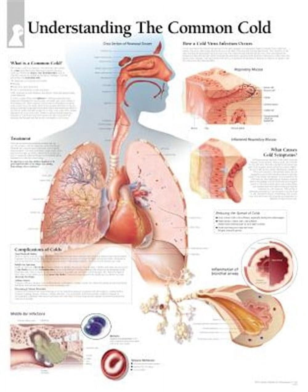 The Common Cold Chart (Other) - Walmart.com