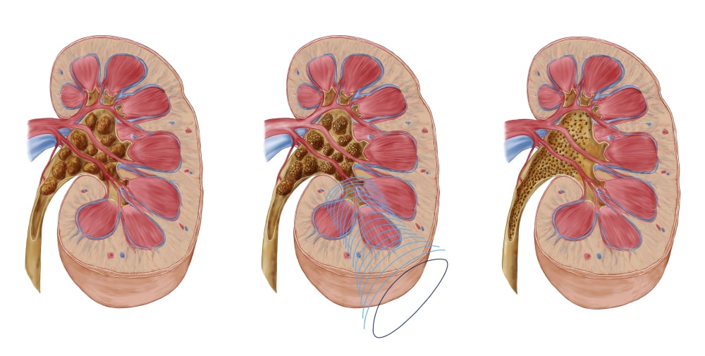 Comparison of different sized kidney stones in the human kidney Canvas Art - Stocktrek Images (39 x 20)