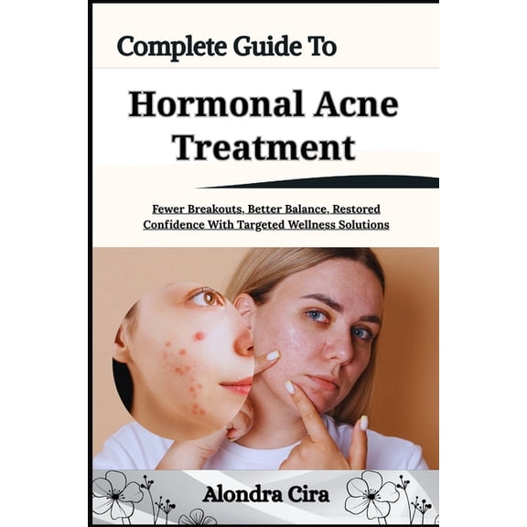 Complete Guide To Hormonal Acne Treatment: Fewer Breakouts, Better Balance Confidence With Targeted Wellness S, (Paperback)