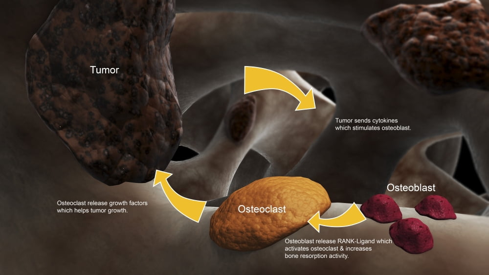 Conceptual image illustrating the process of bone metastasis Canvas Art - Stocktrek Images (38 x 22)