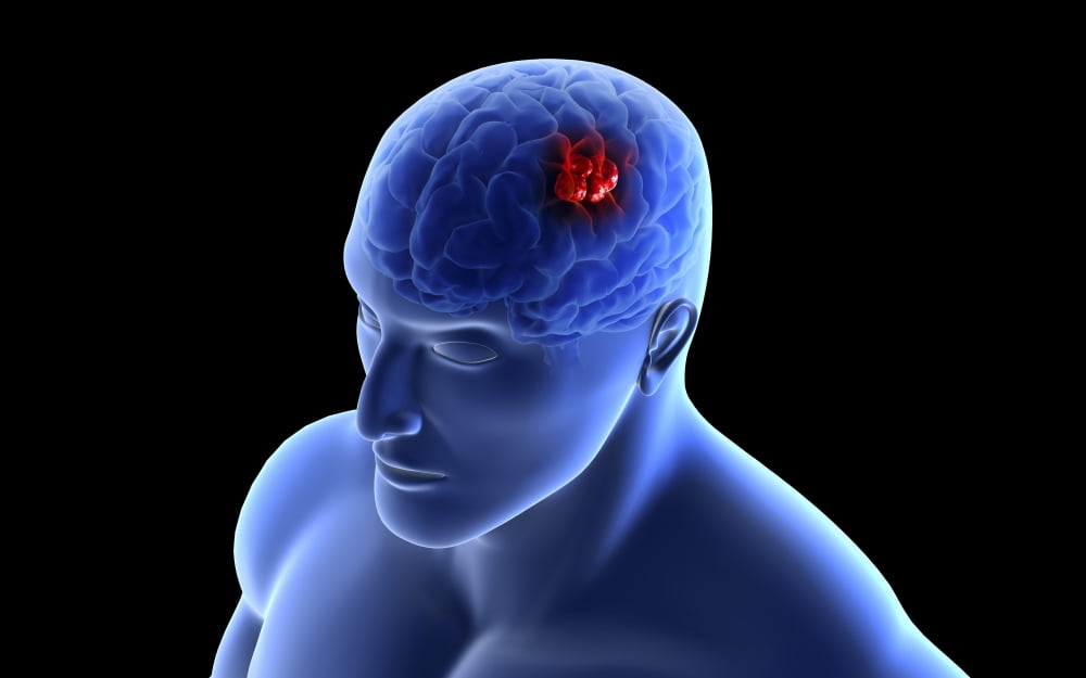 Conceptual image of a tumor in human brain Canvas Art - Stocktrek Images (36 x 23)
