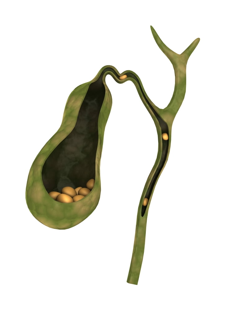 Conceptual image of gallstones inside gall bladder Canvas Art - Stocktrek Images (25 x 33)