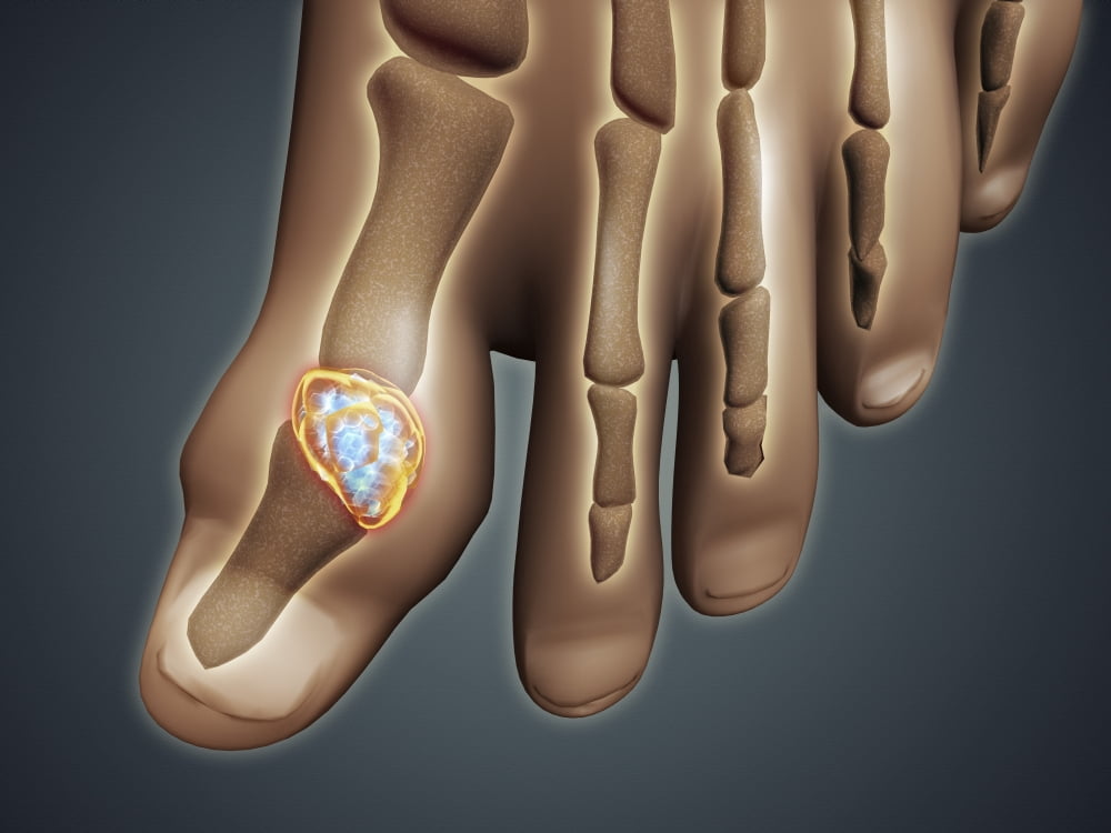 Conceptual image of gout in the big toe Canvas Art - Stocktrek Images (17 x 13)