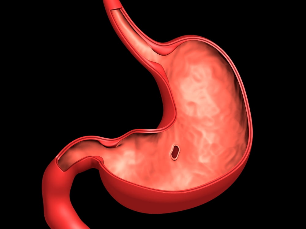 Conceptual image of peptic ulcer in human stomach Canvas Art - Stocktrek Images (17 x 13)