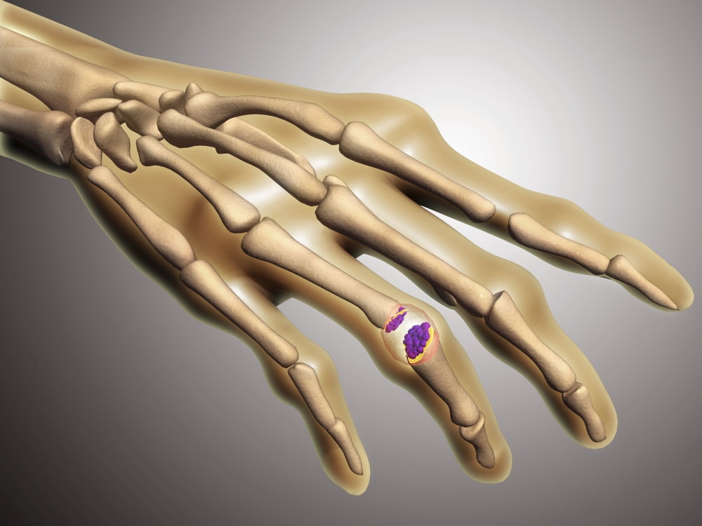 Conceptual image of rheumatoid arthritis in the human hand Canvas Art - Stocktrek Images (17 x 13)