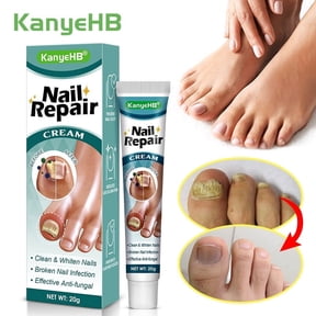 CondFun Nail Repair Cream for Foot Solving Nail rupture, Rough,Split toenails