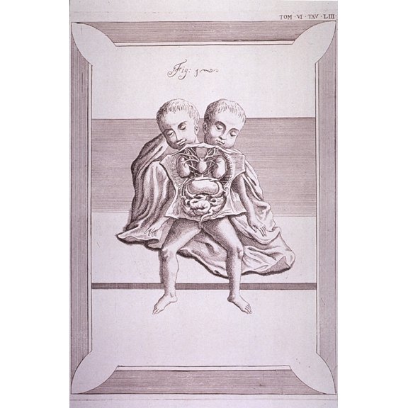 Conjoined Twins With Common Torso And Limbs History (18 x 24)