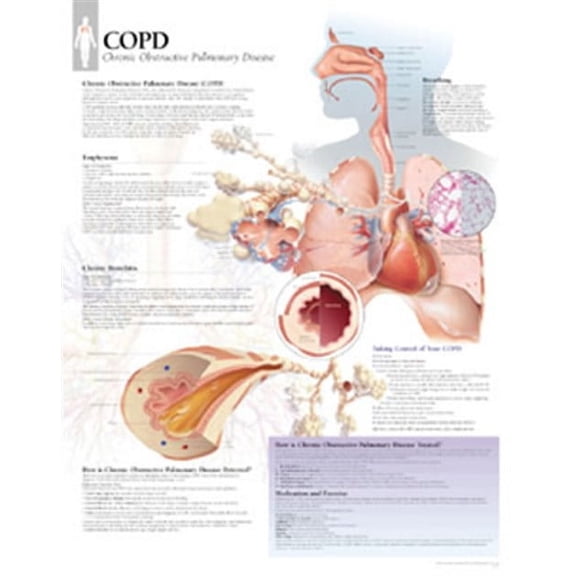 Copd Chart: Laminated Wall Chart: Laminated Wall Chart (Other)