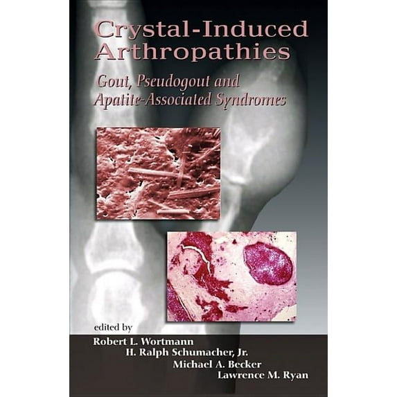Crystal-Induced Arthropathies: Gout, Pseudogout and Apatite-Associated Syndromes (Hardcover)