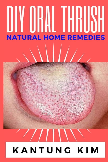 KANTUNG KIM DIY Oral Thrush Natural Home Remedies: The Effective Step By Step Guide To Permanently End Oral Thrush