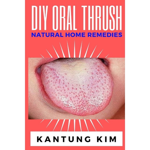 DIY Oral Thrush Natural Home Remedies: The Effective Step By Step Guide To Permanently End Oral Thrush