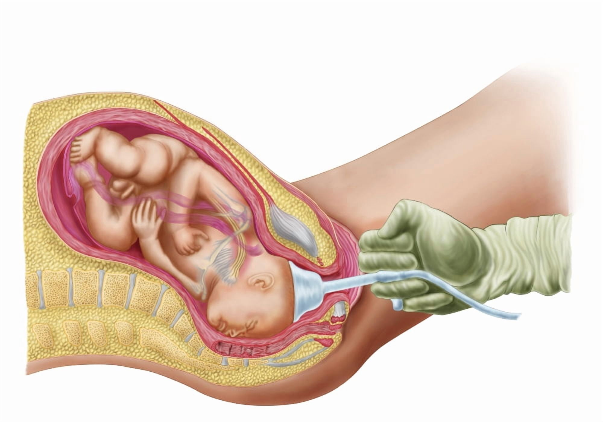 Delivery of fetus using vacuum extraction due to shoulder dystocia Canvas Art - Stocktrek Images (17 x 12)