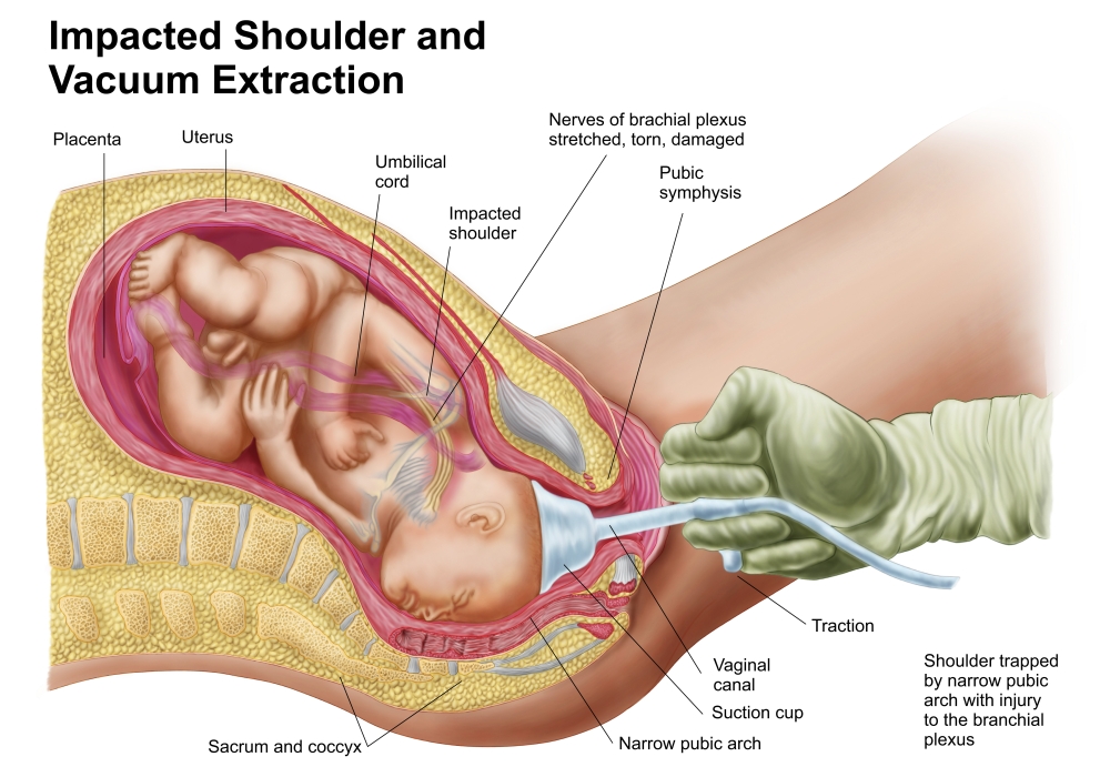 Delivery of fetus using vacuum extraction due to shoulder dystocia Canvas Art - Stocktrek Images (34 x 24)