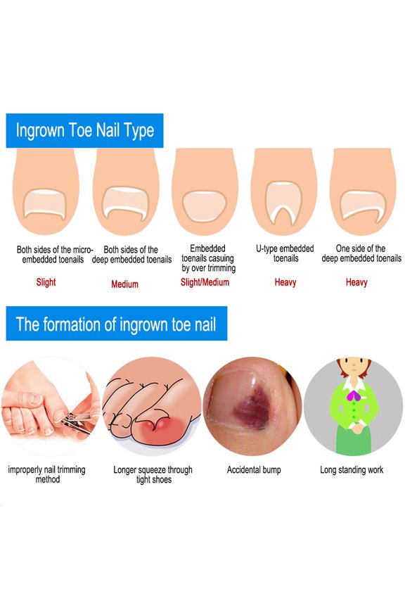 Demonsen Toenail Correction Tool, 12Pcs/Box Pedicure Tool, Profession Or Home Use For Nail Recover Foot Care