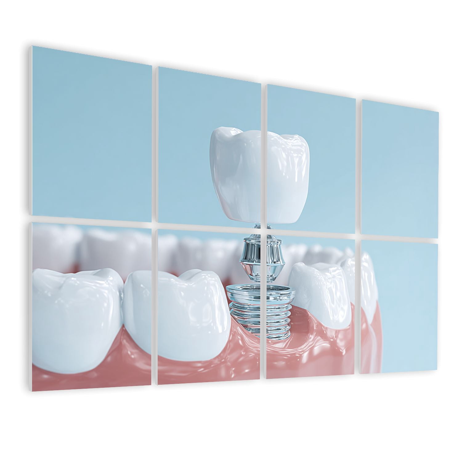 Dental 8 Pack Art Acoustic Panels Sound Absorbing 3D Model Human Gums Dental Implant Blue Decorative Soundproof Wall Panels Self Adhesive for Physician Hospital Office 48"x32"