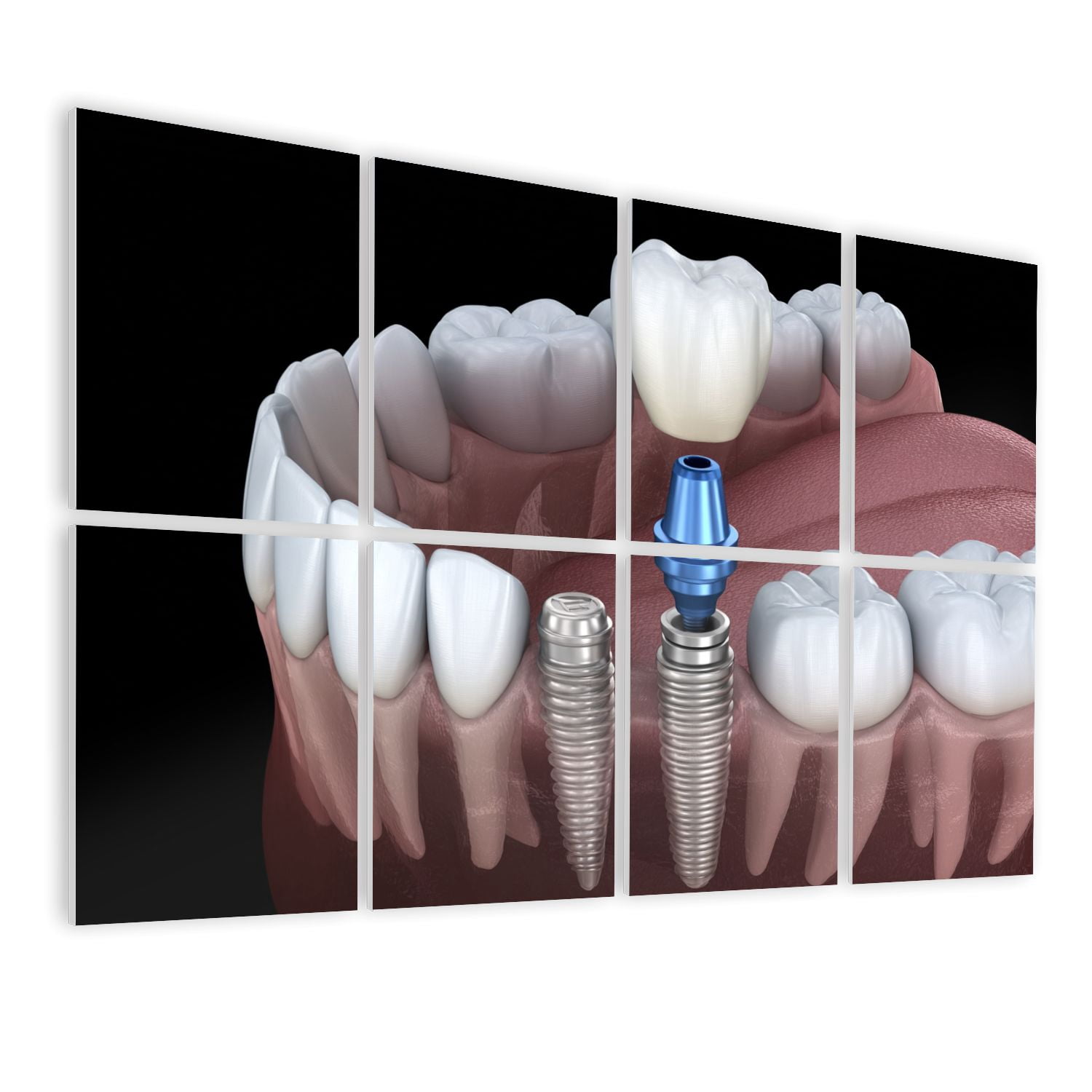 Dental 8 Pack Art Acoustic Panels Sound Absorbing Premolar tooth crown implant abutment Medically Decorative Soundproof Wall Panels Self Adhesive for Physician Hospital Office 48"x32"