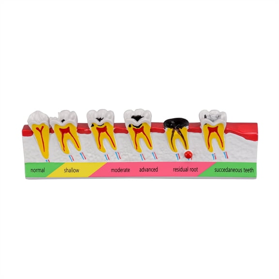 Dental Caries Developing Model, Dental Teeth Model for Dental Tooth Anatomy Study