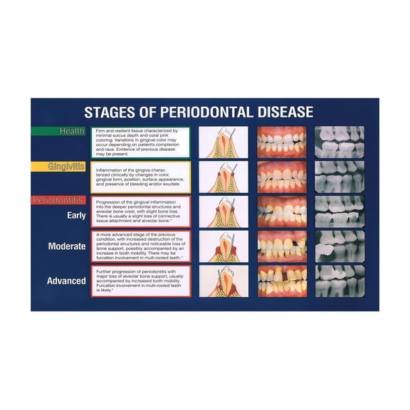 Dental Clinic Wall Art Periodontal Disease Stages Educational Poster Canvas Print for Office Patient Education and Waiting Room Decor