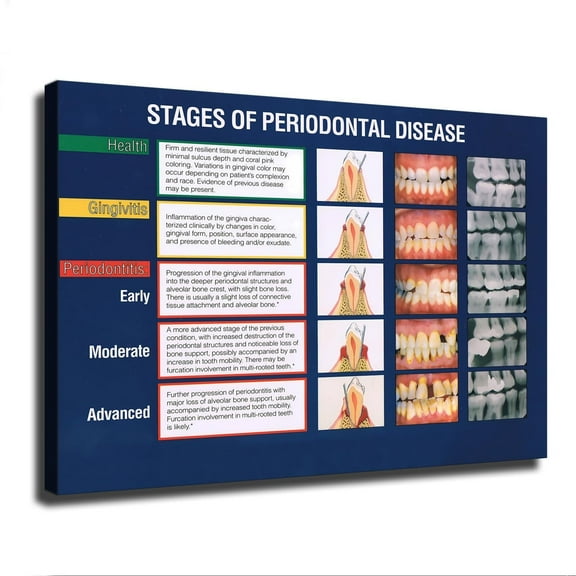 Dental Clinic Wall Poster Posters Of Stages Of Periodontal Disease Canvas Painting Posters And Prints Wall Art Pictures For Living Room Bedroom Decor