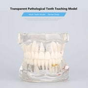 Dental Education Model, Avoid Injuries Tooth Model for Schools