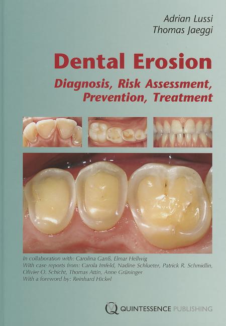 Dental Erosion: Diagnosis, Risk Assessment, Prevention, Treatment