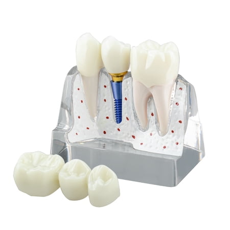 Dental Implant Model for Patient Education, 4 Times Dental Implant
