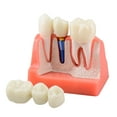 thumbnail image 1 of Dental Implant Model for Patient Education, 4 Times Dental Implant, 1 of 7