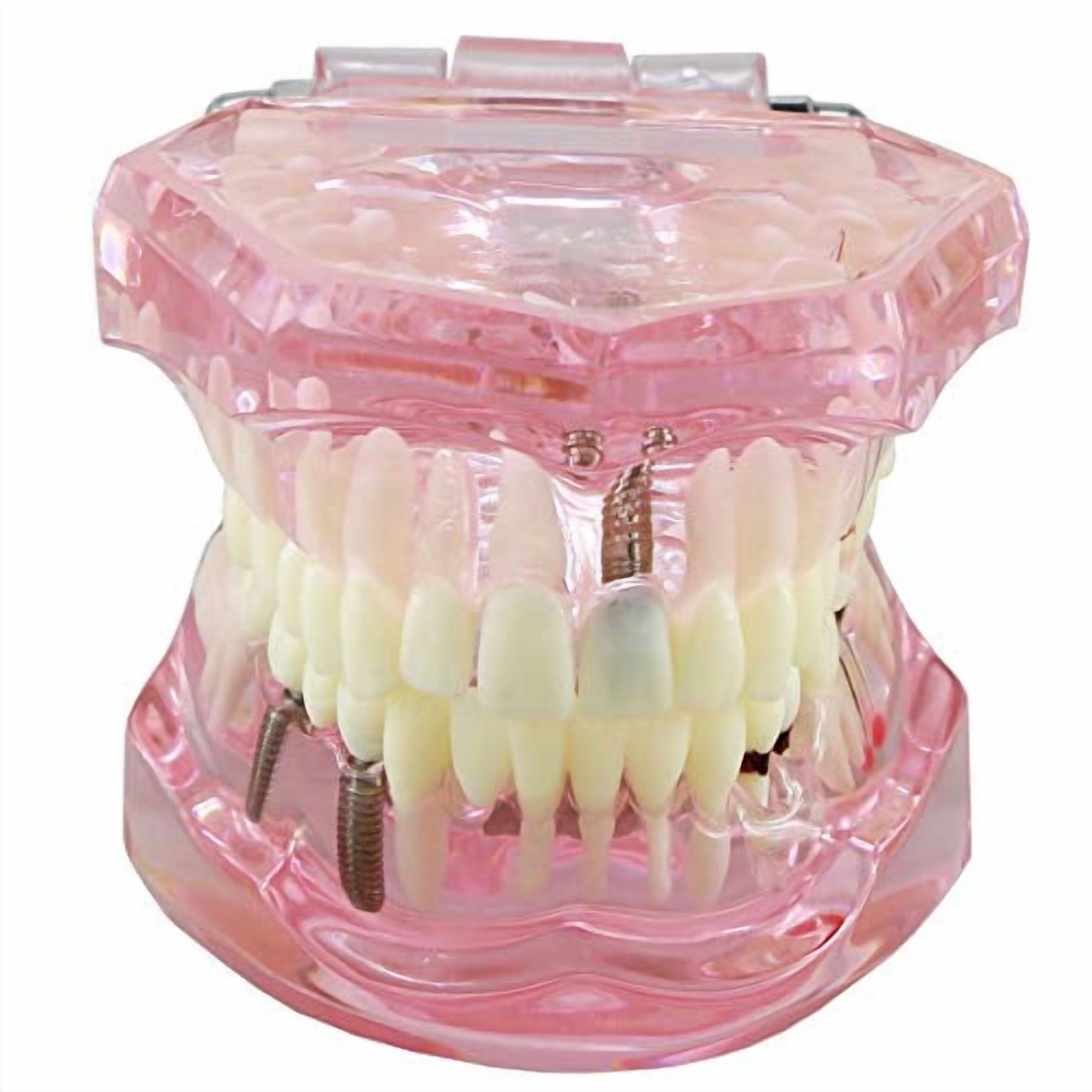 Dental Teeth Model M2001 – Oral Implant Restoration & Pathology Study Typodont Pink