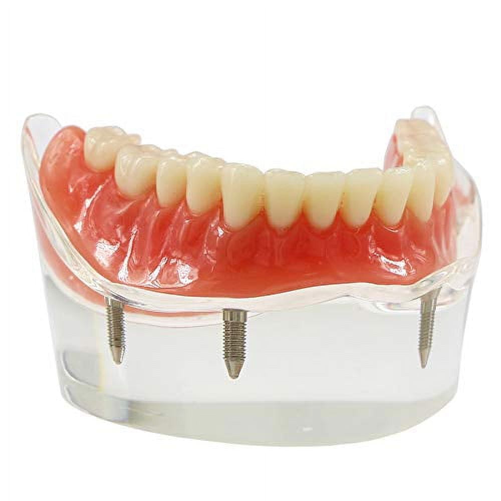 Dental Implant Teeth Model M6003 Typodont Overdenture 4 Implants ...