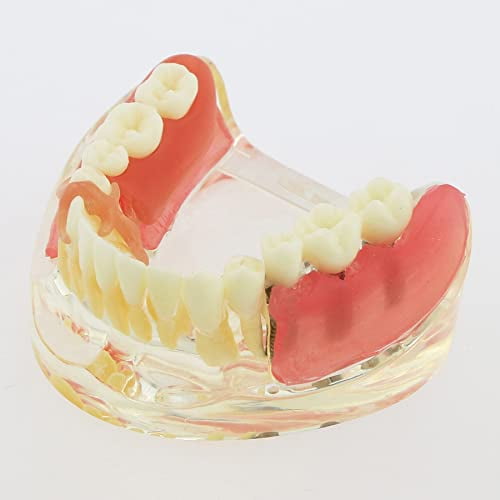 Dental Implant Typodont Restoration Teeth Model M6006 Overdenture 3 ...