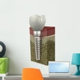thumbnail image 1 of Dental Implant Wall Decal by Wallmonkeys Peel and Stick Graphic (24 in H x 18 in W) WM13191, 1 of 4