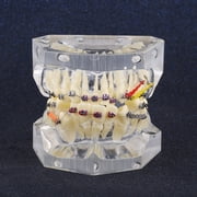 Dental Orthodontic Treatment Malocclusion Study Teeth Model With Wire Chain