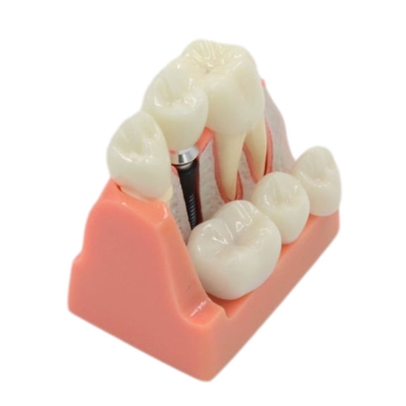 Dental Teeth Model Implant Module for Medical Science Oral Dentist Dentistry