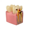 thumbnail image 1 of Dental Tooth Decay Model 6 Times Dental Caries Teeth Model, 1 of 7