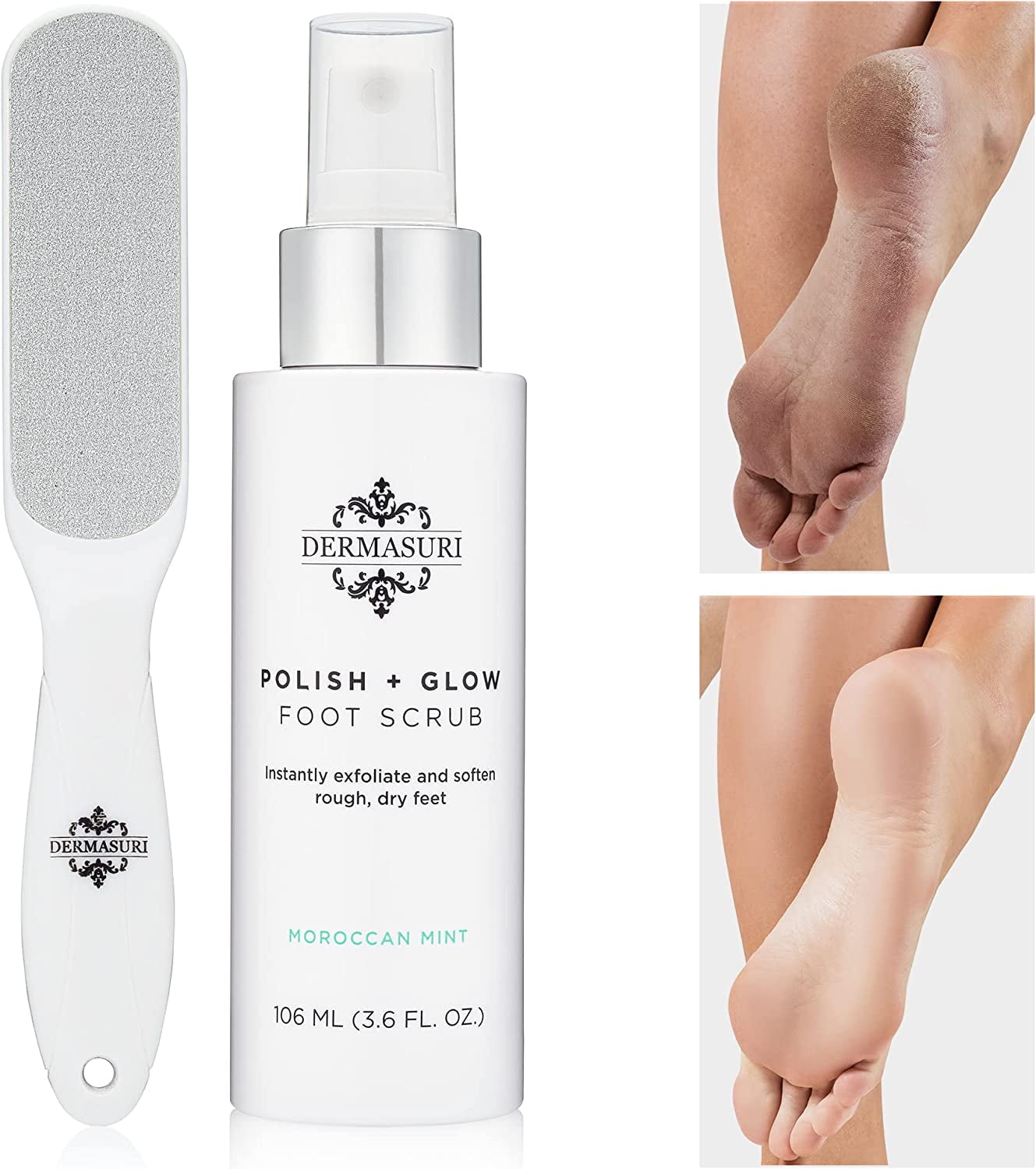 Dermasuri Callus Remover with Spray-on Formula and Foot File, Soften Cracked Heels for Dry Skin