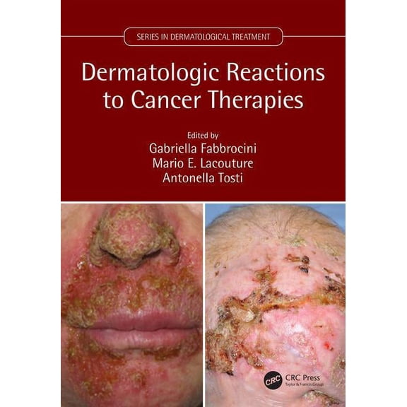 Dermatological Treatment Dermatologic Reactions to Cancer Therapies, (Paperback)