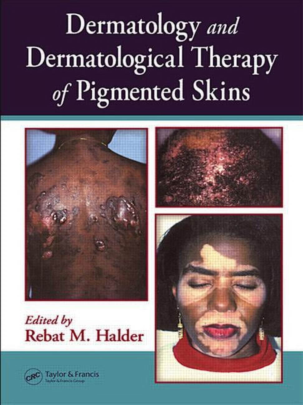 Dermatology and Dermatological Therapy of Pigmented Skins (Hardcover
